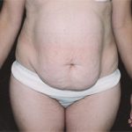 Abdominoplasty Before & After Patient #2402