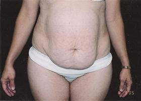 Abdominoplasty Before & After Patient #2402