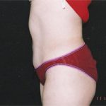 Abdominoplasty Before & After Patient #2402