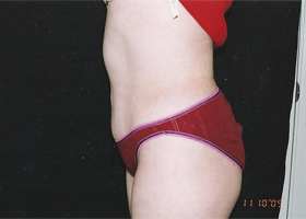 Abdominoplasty Before & After Patient #2402