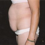 Abdominoplasty Before & After Patient #2402