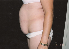 Abdominoplasty Before & After Patient #2402