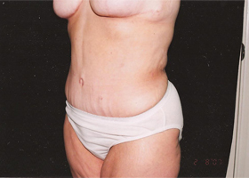 Abdominoplasty Before & After Patient #2403