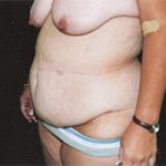 Abdominoplasty Before & After Patient #2403
