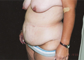 Abdominoplasty Before & After Patient #2403