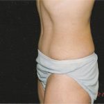Abdominoplasty Before & After Patient #2404