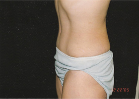 Abdominoplasty Before & After Patient #2404