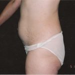 Abdominoplasty Before & After Patient #2404