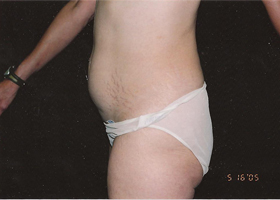 Abdominoplasty Before & After Patient #2404