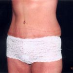 Abdominoplasty Before & After Patient #2410