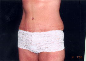 Abdominoplasty Before & After Patient #2410