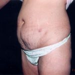 Abdominoplasty Before & After Patient #2410