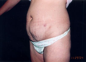 Abdominoplasty Before & After Patient #2410