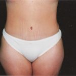 Abdominoplasty Before & After Patient #2401