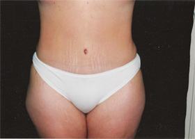 Abdominoplasty Before & After Patient #2401