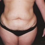 Abdominoplasty Before & After Patient #2401