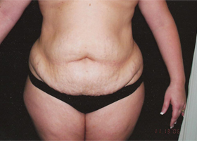Abdominoplasty Before & After Patient #2401