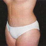 Abdominoplasty Before & After Patient #2401