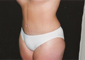 Abdominoplasty Before & After Patient #2401