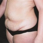Abdominoplasty Before & After Patient #2401