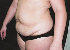 Abdominoplasty Before & After Patient #2401