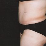 Abdominoplasty Before & After Patient #2400