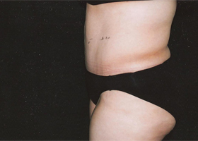 Abdominoplasty Before & After Patient #2400