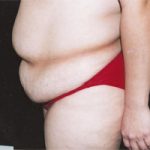 Abdominoplasty Before & After Patient #2400