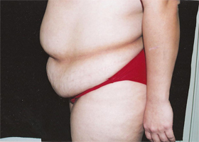 Abdominoplasty Before & After Patient #2400