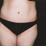 Abdominoplasty Before & After Patient #2400