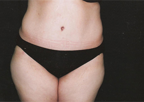 Abdominoplasty Before & After Patient #2400