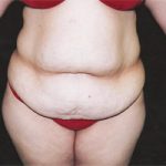 Abdominoplasty Before & After Patient #2400