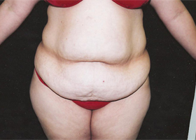 Abdominoplasty Before & After Patient #2400