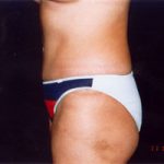 Abdominoplasty Before & After Patient #2405