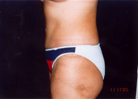 Abdominoplasty Before & After Patient #2405