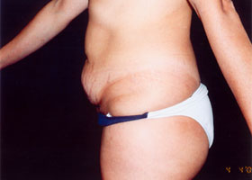 Abdominoplasty Before & After Patient #2405