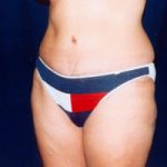 Abdominoplasty Before & After Patient #2405