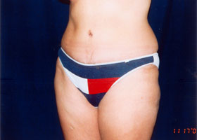 Abdominoplasty Before & After Patient #2405