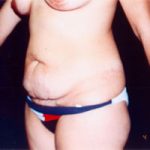Abdominoplasty Before & After Patient #2405