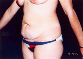 Abdominoplasty Before & After Patient #2405
