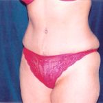 Abdominoplasty Before & After Patient #2409