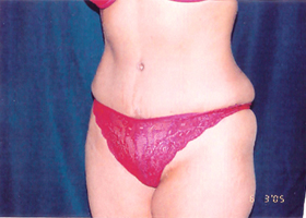 Abdominoplasty Before & After Patient #2409