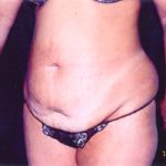 Abdominoplasty Before & After Patient #2409