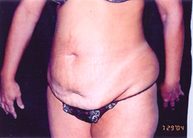 Abdominoplasty Before & After Patient #2409