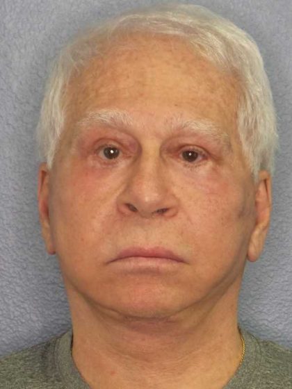 Facelift Before & After Patient #11809