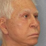Facelift Before & After Patient #11809