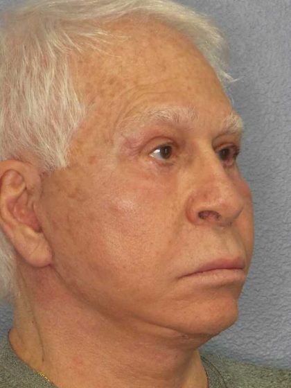 Facelift Before & After Patient #11809