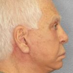 Facelift Before & After Patient #11809