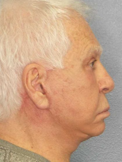 Facelift Before & After Patient #11809