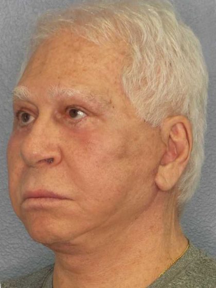 Facelift Before & After Patient #11809